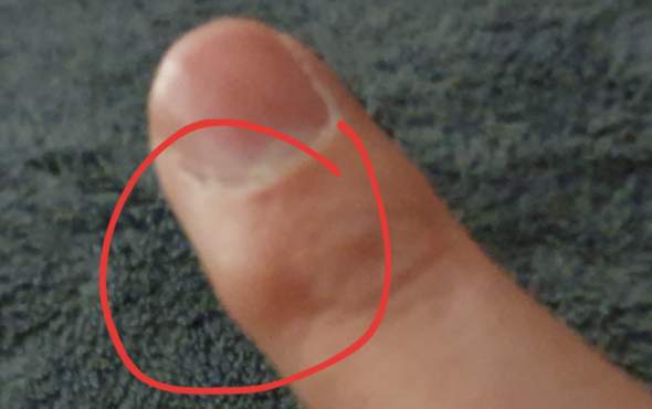 Knubbel Am Mittel Und Kleinenfinger Wie Weggekommen Computer Hand Knubbel Am Mittel Und Kleinenfinger Wie Weggekommen Computer Hand