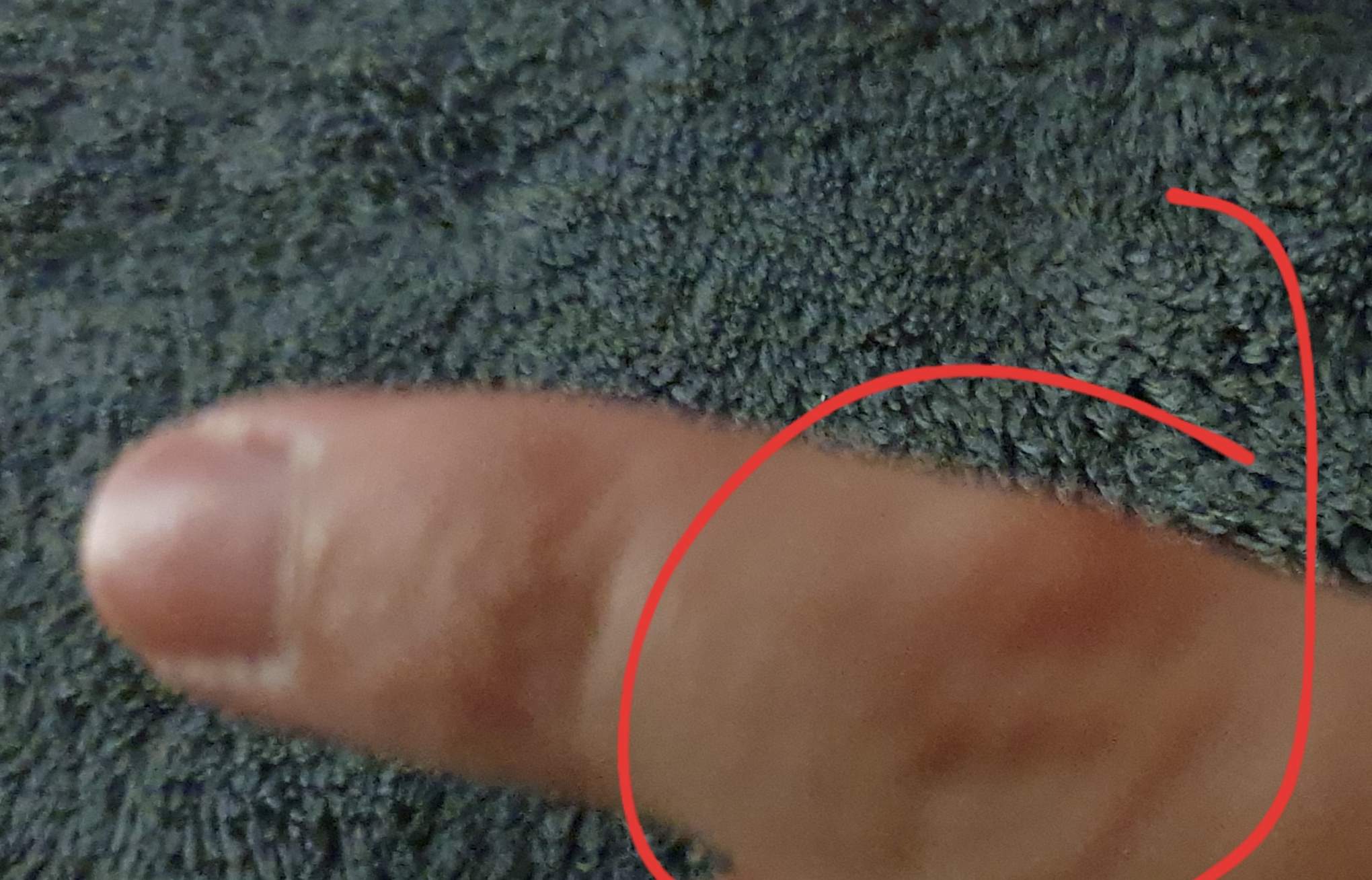 Knubbel am Mittel und Kleinenfinger wie weggekommen? Hand) Knubbel am Mittel und Kleinenfinger wie weggekommen? Hand)