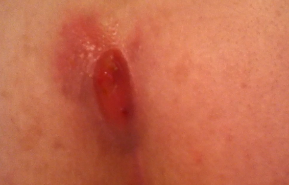 Knubbel Am Po Ende Richtung Rucken Krankheit Schmerzen Knubbel Am Po Ende Richtung Rucken Krankheit Schmerzen