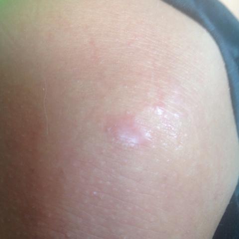 Knubbel An Ellenbogen Und Knie Arzt Haut Behandlung Knubbel An Ellenbogen Und Knie Arzt Haut Behandlung