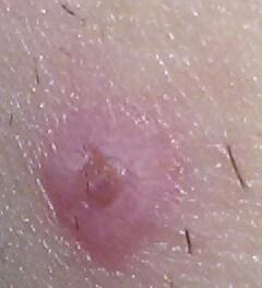 Knubbel Auf Der Haut Angst Innen Knubbel Auf Der Haut Angst Innen