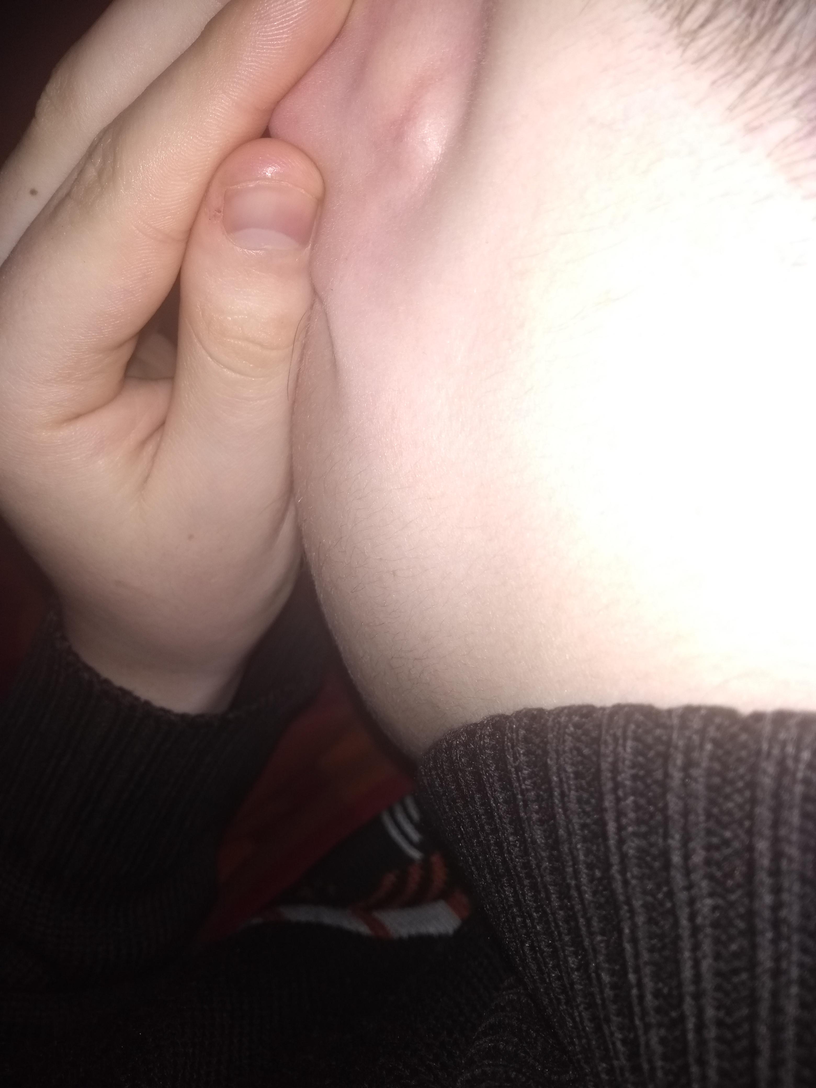 Knubbel Hinter Linkem Ohr Gesundheit Und Medizin Krebs Knubbel Hinter Linkem Ohr Gesundheit Und Medizin Krebs