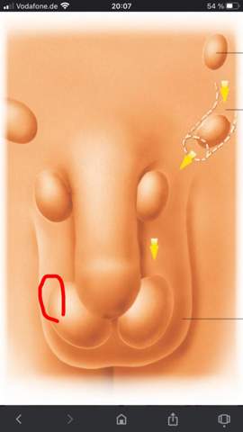 Penis knubbel Tumor im