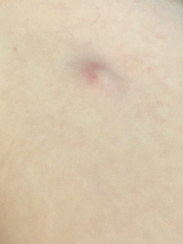 Knubbel Im Nacken Tumor Knubbel Im Nacken Tumor