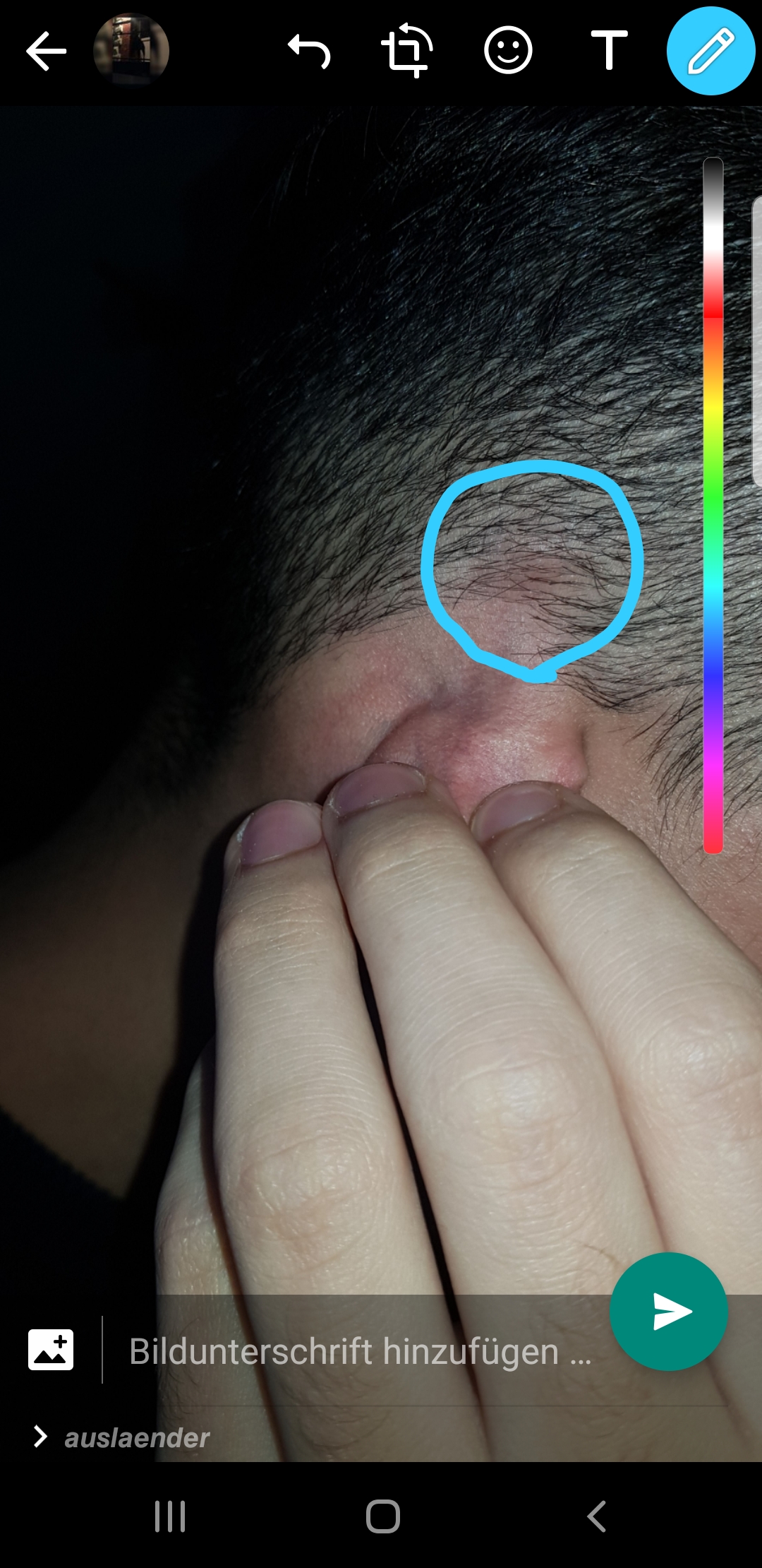 Knubbel Uber Dem Ohr Haut Beule Knubbel Uber Dem Ohr Haut Beule