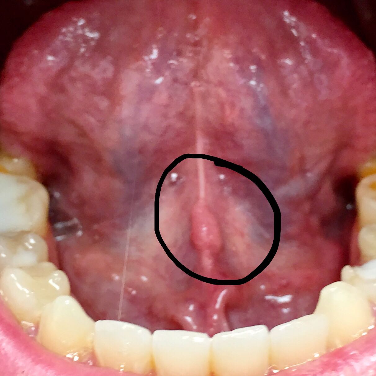 33+ Knoten unter der zunge bilder , Knubbel unter dem Zungenbändchen schlimm? (Arzt, Zunge, Medical)