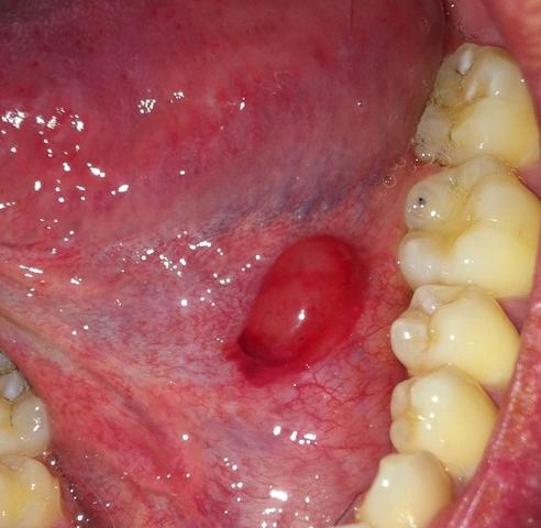 Knubbel Unter Der Zunge Was Ist Das Medizin Knubbel Unter Der Zunge Was Ist Das Medizin