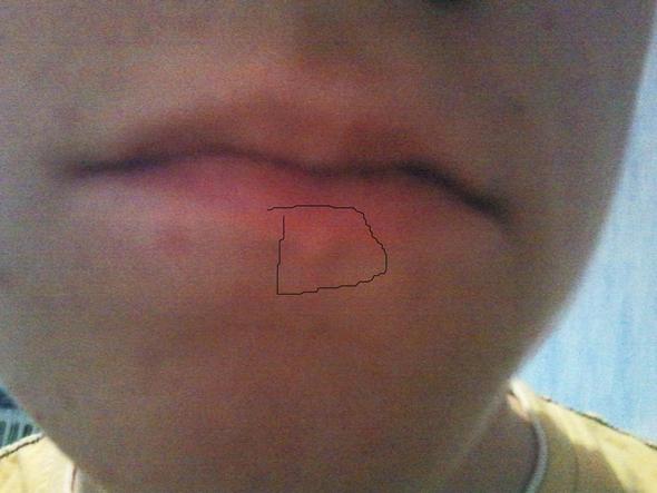 Knubbel Unter Unterlippe Gesundheit Medizin Lippe Knubbel Unter Unterlippe Gesundheit Medizin Lippe