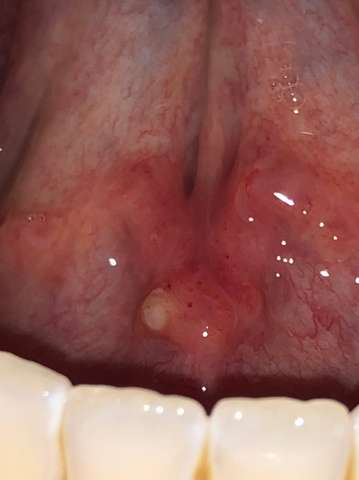 Knubbel Unter Zunge An Speicheldruse Gesundheit Knubbel Unter Zunge An Speicheldruse Gesundheit