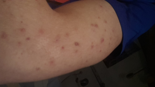Knubbelige Pickel am Körper? Was genau ist es und was kann man dagegen tun Bitte Hilfe? (Akne pickel am körper