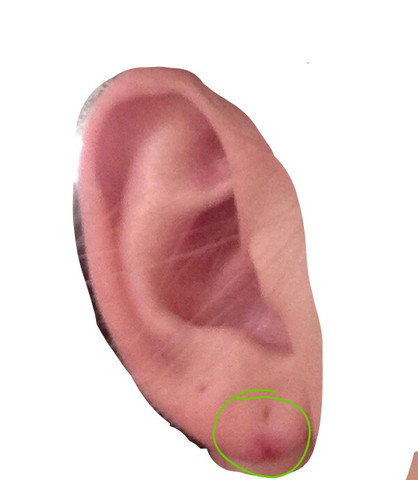 Das Ohr mit dem Fleck (grün) - (Gesundheit, Körper, Ohr)