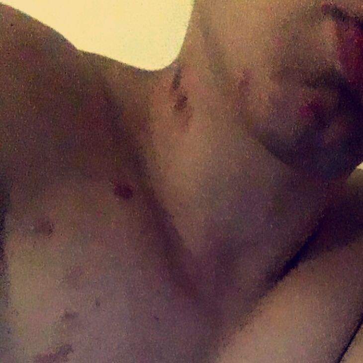 Ohne machen flasche knutschfleck selber hals Einen Knutschfleck