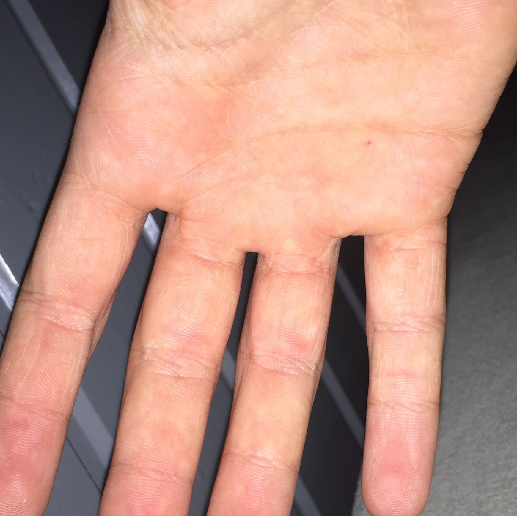 Kömische Rote Punkte auf der Linken Hand, unterhalb der Finger, was is das? (Link, Flecken Kömische Rote Punkte auf der Linken Hand, unterhalb der Finger, was is das? (Link, Flecken