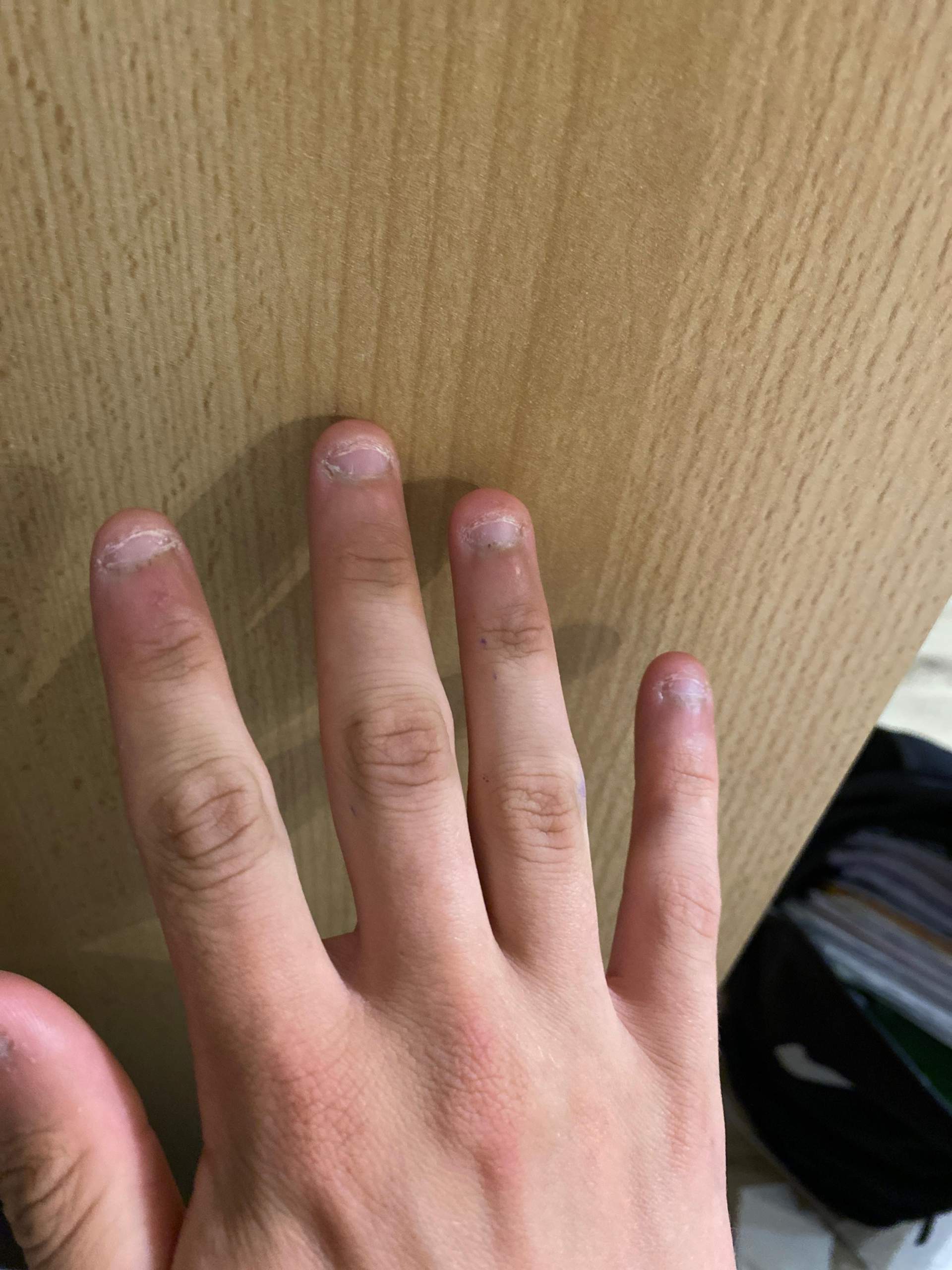 Können Nagelbetten wieder nachwachsen? (Gesundheit und Medizin, Nägelkauen)