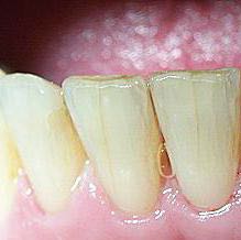 Können solche risse in den Zähnen wieder zusammenwachsen? (Gesundheit ...