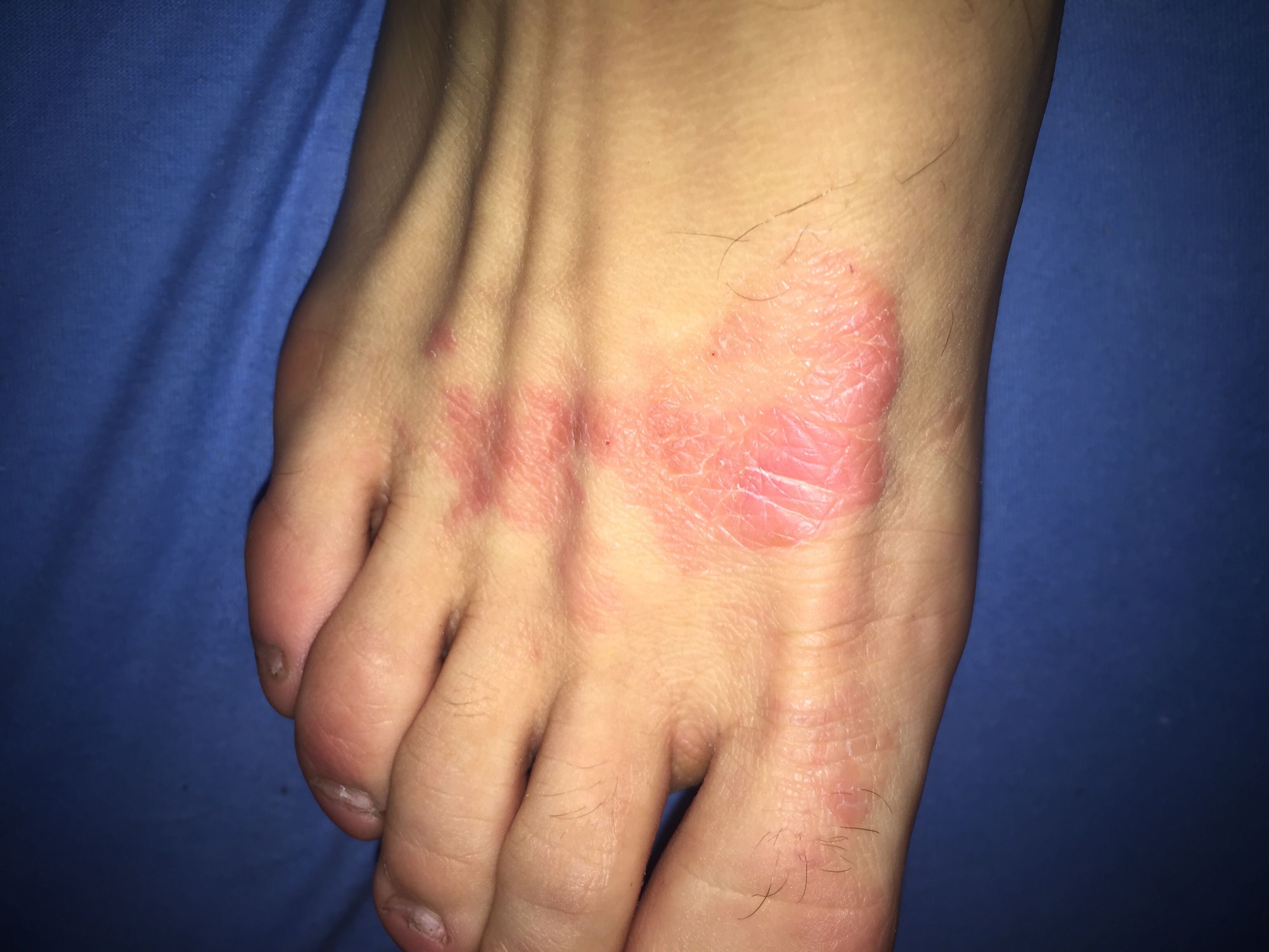 Könnt ihr mir sagen was das ist? Brauche hilfe (Füße, Rötung)