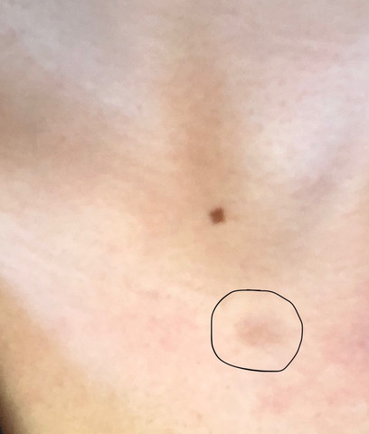 Konnte Das Auf Dem Bild Hautkrebs Sein Haut Hautarzt Hautprobleme Konnte Das Auf Dem Bild Hautkrebs Sein Haut Hautarzt Hautprobleme