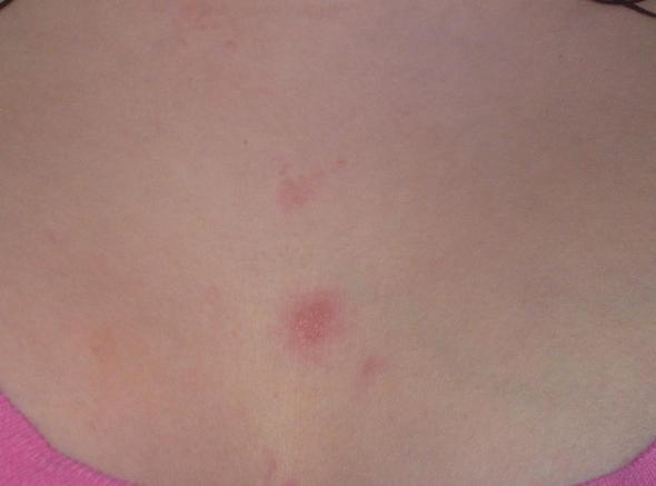 Konnte Das Ein Hiv Ausschlag Sein