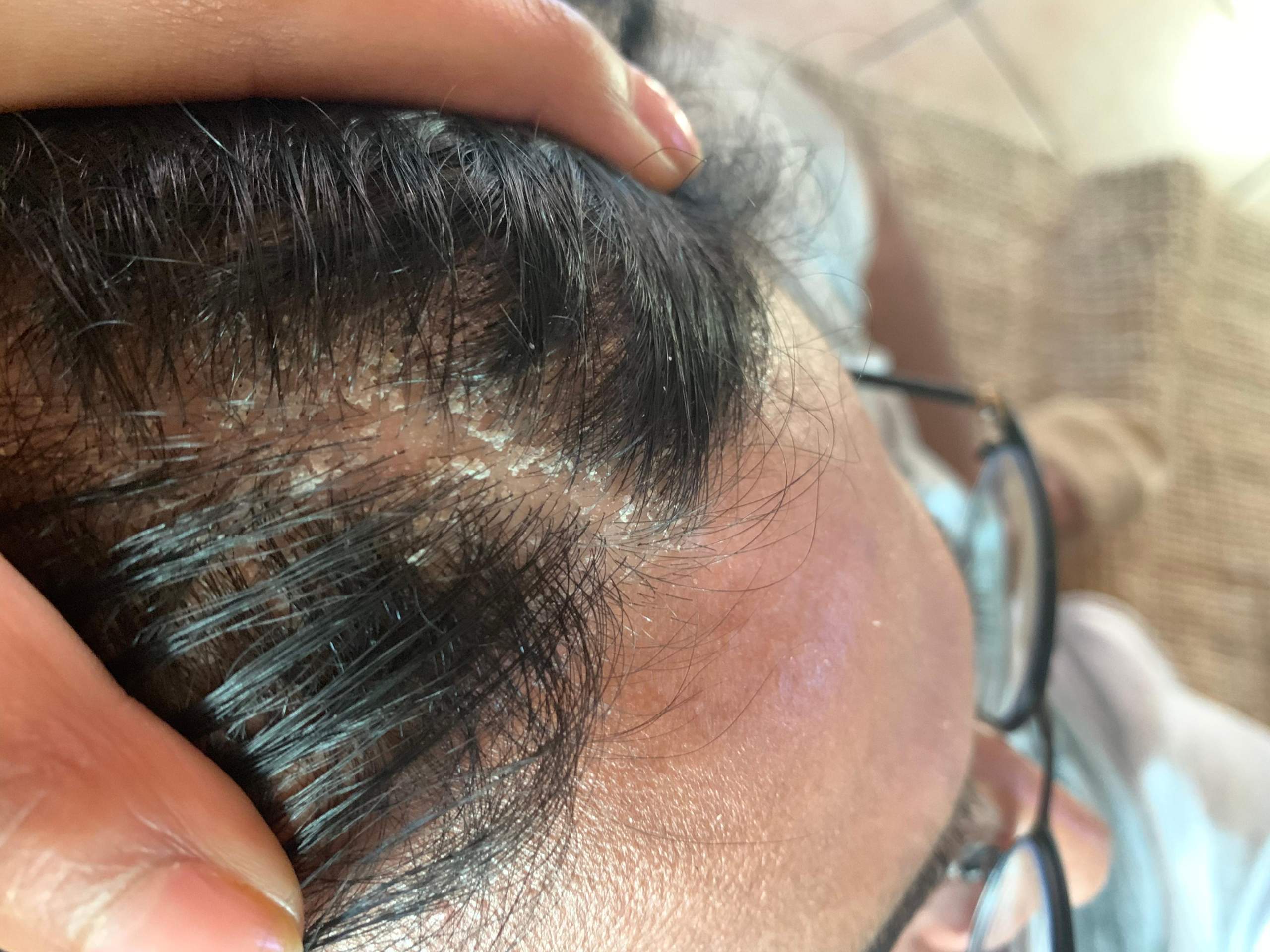 Könnte das ein Pilz auf der Kopfhaut sein? (Gesundheit und Medizin, Dermatologie, Hautpilz) Könnte das ein Pilz auf der Kopfhaut sein? (Gesundheit und Medizin, Dermatologie, Hautpilz)