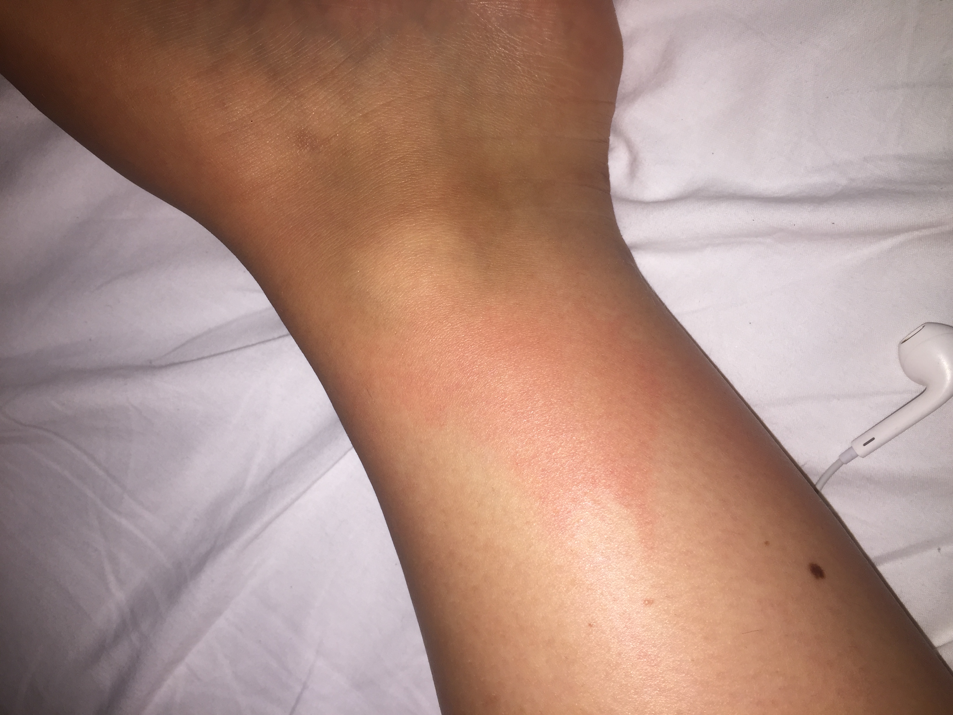 Könnte das eine wundrose sein? (Gesundheit, Medizin, Krankheit) Könnte das eine wundrose sein? (Gesundheit, Medizin, Krankheit)