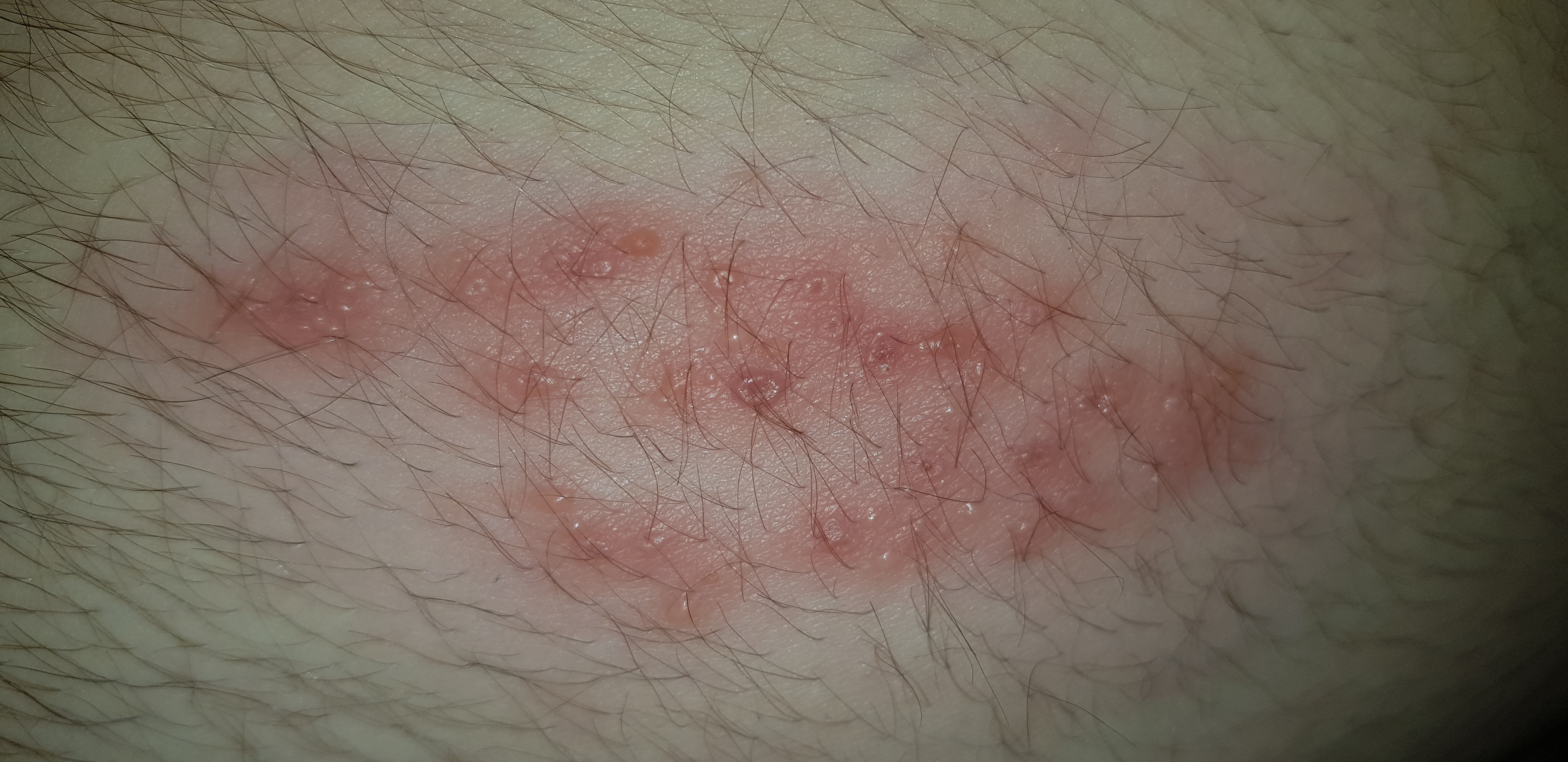 Könnte das Gürtelrose sein? Habe es schon mehrere Tage? (Gesundheit und ...