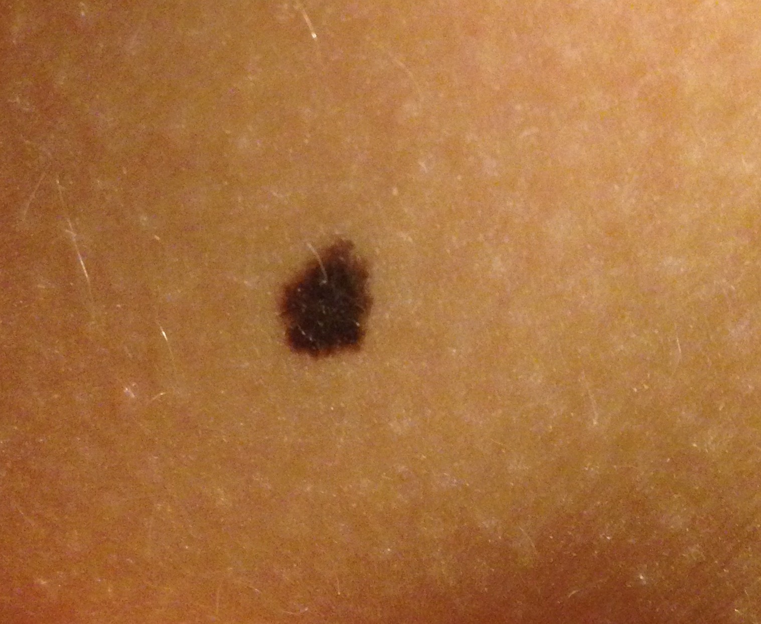 Könnte das Hautkrebs sein. Oder ein Muttermal? Könnte das Hautkrebs sein. Oder ein Muttermal?