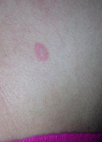 Konnte Dieser Fleck Hautkrebs Sein Siehe Bild Gesundheit Krankheit Haut Konnte Dieser Fleck Hautkrebs Sein Siehe Bild Gesundheit Krankheit Haut