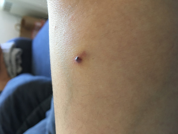 Konnte Es Ein Anzeichen An Hautkrebs Sein Arzt Haut Sicherheit Konnte Es Ein Anzeichen An Hautkrebs Sein Arzt Haut Sicherheit