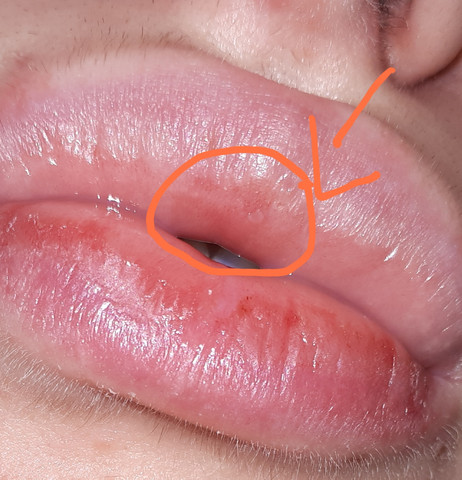 Konnte Es Herpes Sein Gesundheit Herpesblaschen Konnte Es Herpes Sein Gesundheit Herpesblaschen