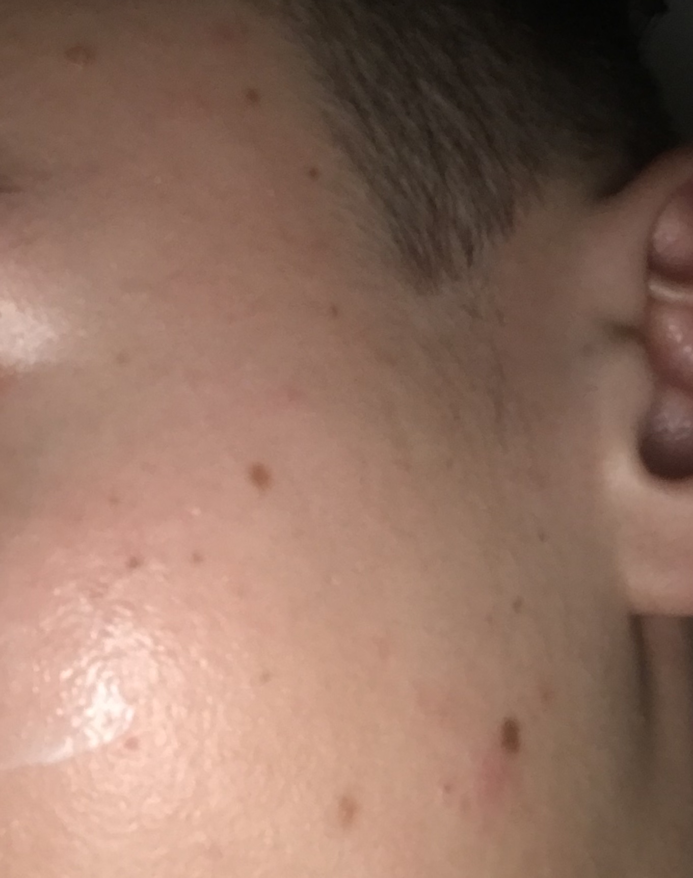 Könnte man diese muttermale im gesicht weglasern lassen? (Haut, Muttermal)