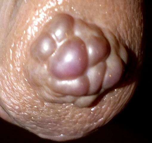 Konnte Mir Jemmand Sagen Was Ich Auf Der Eichel Habe Ich Habe Seit Ich 9 Bin Eine Komische Dunkle Blasse Die So Aussieht Wie Blumenkohl Gesundheit Sex Medizin Konnte Mir Jemmand Sagen Was Ich Auf Der Eichel Habe Ich Habe Seit Ich 9 Bin Eine Komische Dunkle Blasse Die So Aussieht Wie Blumenkohl Gesundheit Sex Medizin