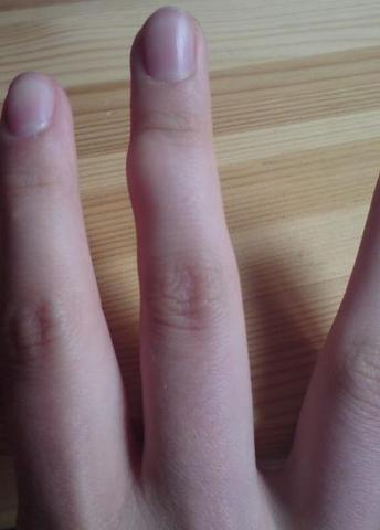 Knubbel am finger