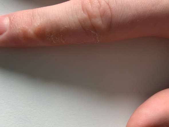 Komische Bläschen am Finger? (Gesundheit und Medizin, Gesundheit, Medizin)