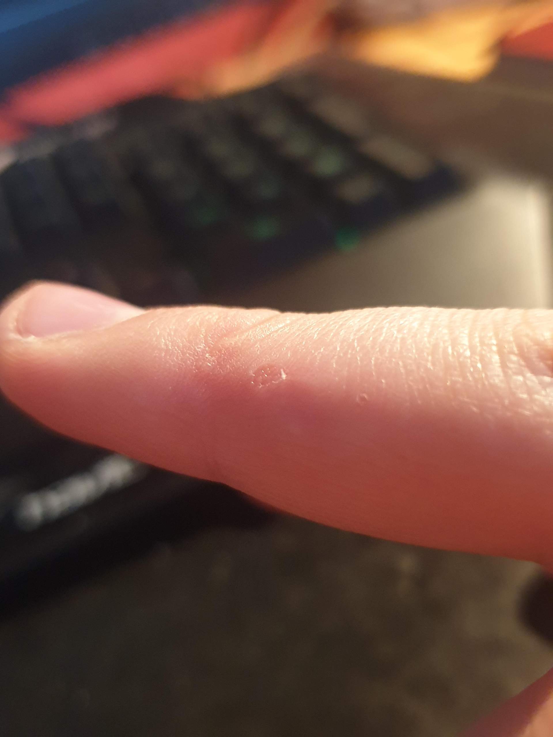 kleine bläschen an den fingern