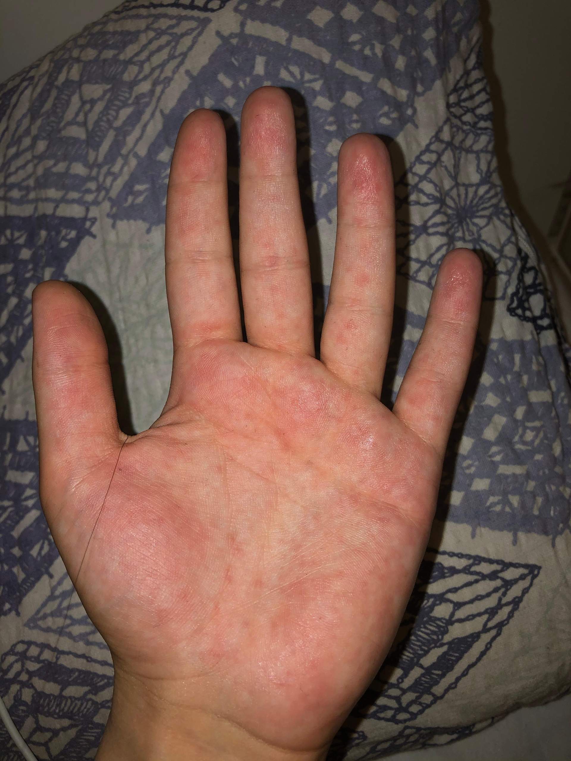 Komische Bläschen auf der Hand?!? (Gesundheit und Medizin, Gesundheit