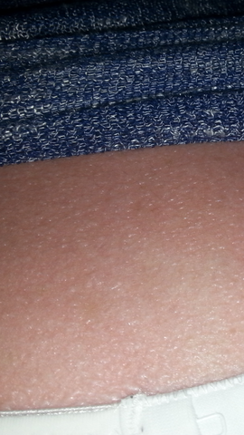 Komische Blaschen Auf Sonnenbrand Mit Foto Blasen Komische Blaschen Auf Sonnenbrand Mit Foto Blasen