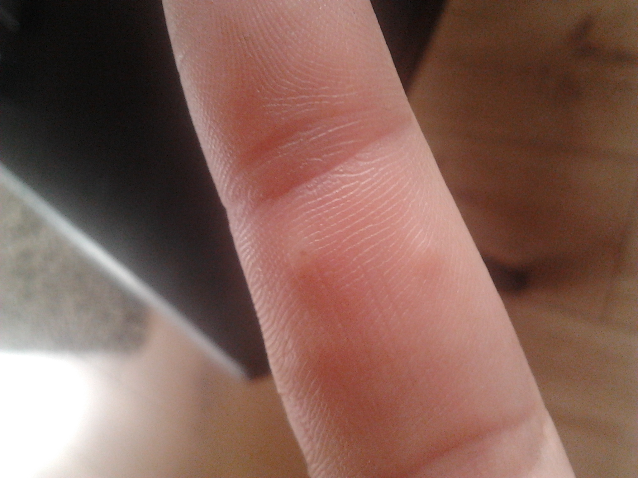 Komische Blasen am Finger (Haut, Blase)
