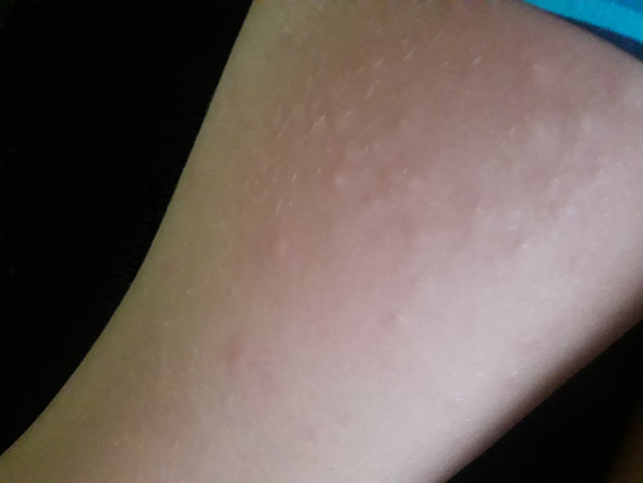 Komische Blasen/ Pickeln? (Pickel, jucken) pickel jucken