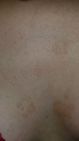Komische Braune Flecken Zwischen Der Brust Gesundheit Madchen Arzt