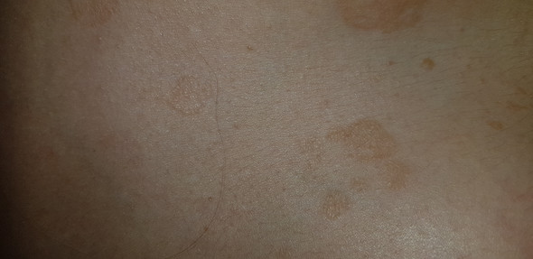 Komische braune Flecken zwischen der Brust? (Gesundheit, Mädchen, Arzt) Komische braune Flecken zwischen der Brust? (Gesundheit, Mädchen, Arzt)