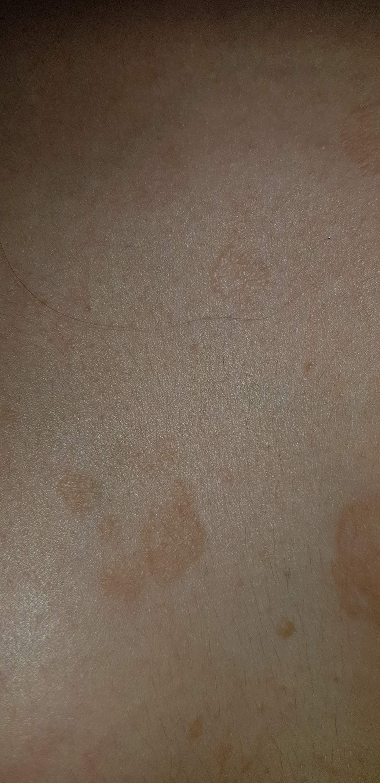 Komische braune Flecken zwischen der Brust? (Mädchen, Gesundheit, Arzt)