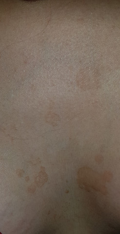 Komische Braune Flecken Zwischen Der Brust Gesundheit Madchen Arzt Komische Braune Flecken Zwischen Der Brust Gesundheit Madchen Arzt