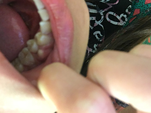 Komische Eiterblase An Meinem Zahn Was Tun Zahne Zahnarzt Zahnfleisch