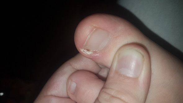 Komische Entzundung An Grossen Zeh Fusse Komische Entzundung An Grossen Zeh Fusse