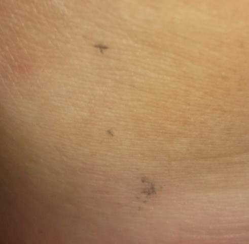 Schwarze Flecken  - (Operation, Flecken, Hautkrebs)