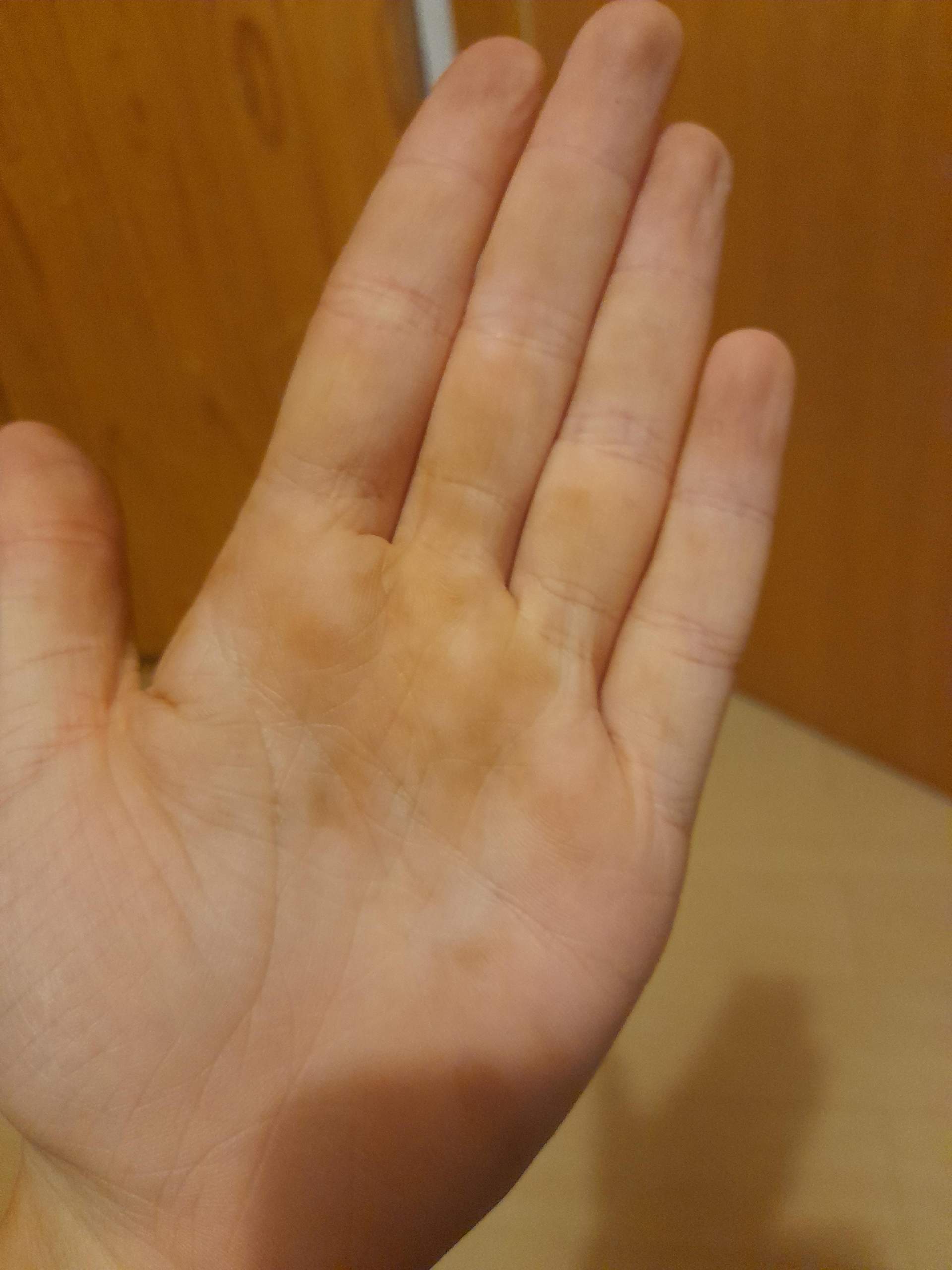 Komische Flecken auf der Hand? (Gesundheit, Sauberkeit) Komische Flecken auf der Hand? (Gesundheit, Sauberkeit)