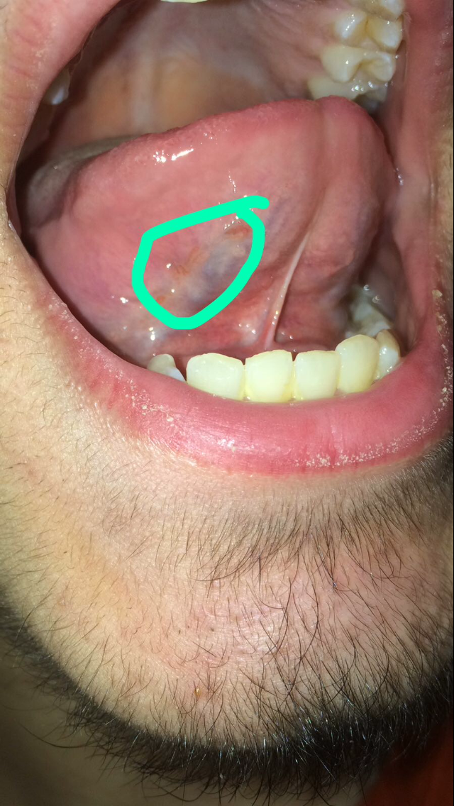 Pickel Auf Der Zunge - Weißer Punkt auf der Zunge seitlich - Denta