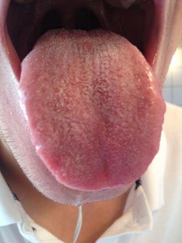Zunge - (Medizin, Krankheit, Mund)