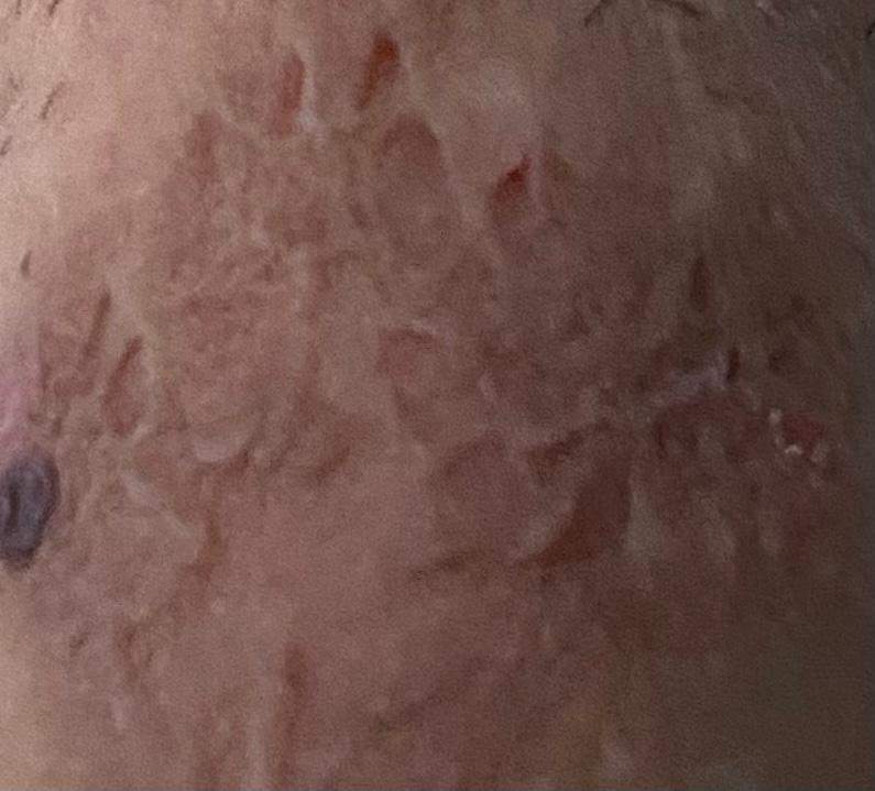 Penis risse am Hautrisse am