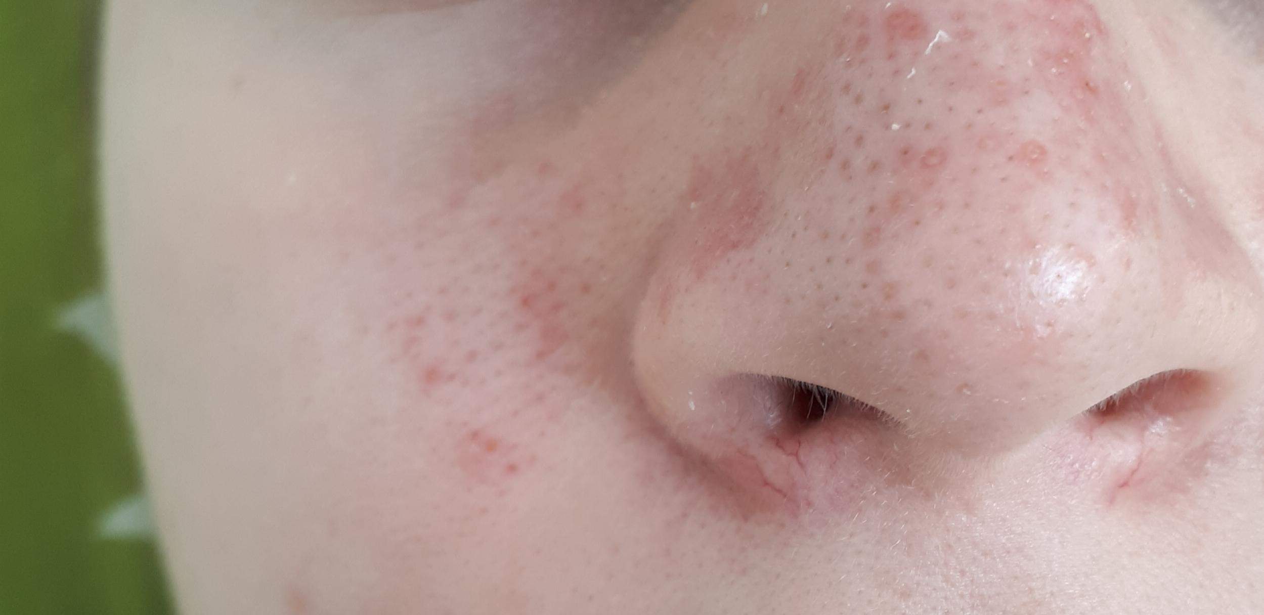 Komische Haut im Nasenbereich? (Gesundheit und Medizin, rote-punkte